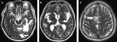 Neurosyphilis with positive anti-N-methyl-D-aspartate receptor antibody: a case report